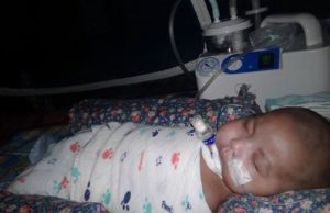 Bayi sindrom dagu kecil perlu mesin sedut kahak
