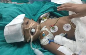 Kembar craniopagus India sudah boleh buka mata