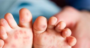 HFMD cases children infectious disease Kes penyakit tangan, kaki dan mulut (HFMD) di negeri ini dikesan meningkat hampir 50 peratus sepanjang tahun ini setakat semalam berbanding tempoh sama tahun lalu.