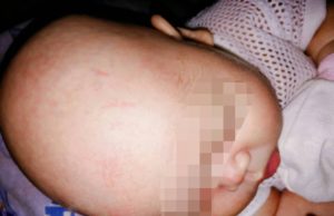 Kesan gigitan pada kepala bayi berusia 20 hari gara-gara digigit oleh bapanya sendiri kerana tidak tahan mendengar anaknya itu kerap menangis,