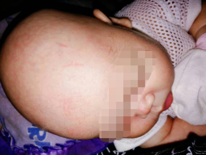 Kesan gigitan pada kepala bayi berusia 20 hari gara-gara digigit oleh bapanya sendiri kerana tidak tahan mendengar anaknya itu kerap menangis,