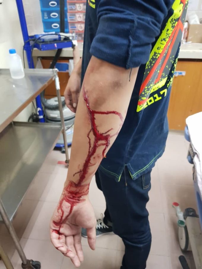 KECEDERAAN salah seorang anggota polis yang dilibas dengan kerambit oleh seorang lelaki yang pada mulanya ditahan kerana mencuri kipas dinding dalam kejadian di Bayan Baru, Pulau Pinang.