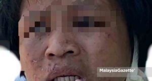 maid abuse domestic helper The injuries on the victim’s face, believed to be abused by her employers.