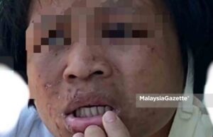 maid abuse domestic helper The injuries on the victim’s face, believed to be abused by her employers.