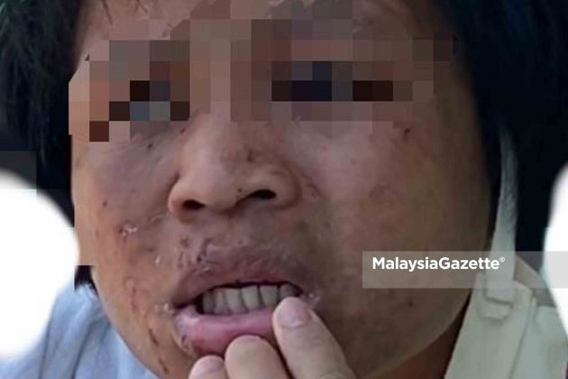 maid abuse domestic helper The injuries on the victim’s face, believed to be abused by her employers.