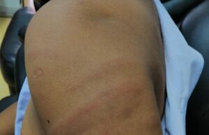 A Primary Year 3 student was beaten by his teacher in Kuala Kedah yesterday.