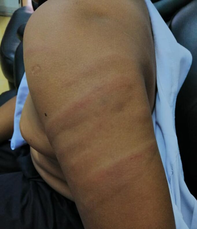 A Primary Year 3 student was beaten by his teacher in Kuala Kedah yesterday.