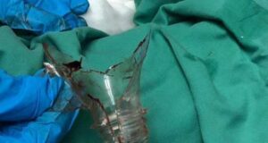 The 47-year-old man's penis got stuck in the plastic bottle