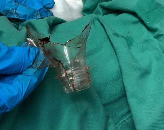 The 47-year-old man's penis got stuck in the plastic bottle