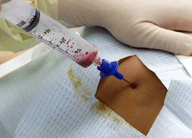 Multiple Myeloma: Tanda amaran dan apa yang perlu tahu