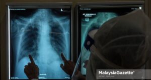 Healthcare worker examining the x-ray result of a Covid-19 patient at the Intensive Care Unit (ICU) of the Kuala Lumpur Hospital. PIX: MOHD ADZLAN / MalaysiaGazette / 04 JUNE 2021 Covid-19 cases