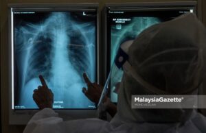 Healthcare worker examining the x-ray result of a Covid-19 patient at the Intensive Care Unit (ICU) of the Kuala Lumpur Hospital. PIX: MOHD ADZLAN / MalaysiaGazette / 04 JUNE 2021 Covid-19 cases