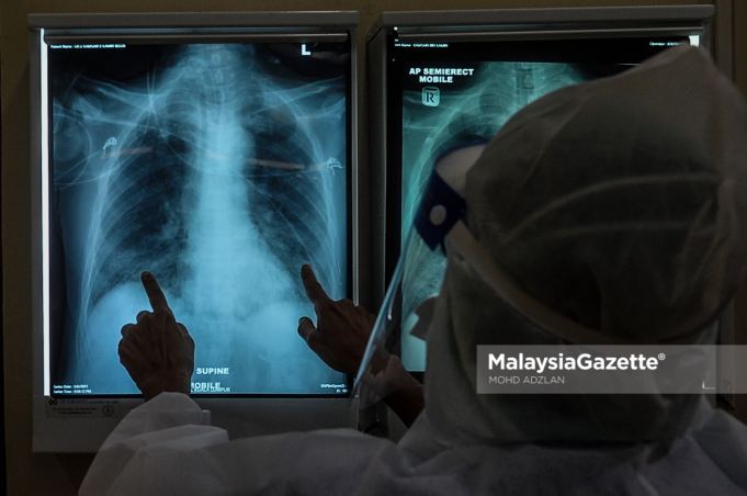 Healthcare worker examining the x-ray result of a Covid-19 patient at the Intensive Care Unit (ICU) of the Kuala Lumpur Hospital. PIX: MOHD ADZLAN / MalaysiaGazette / 04 JUNE 2021 Covid-19 cases