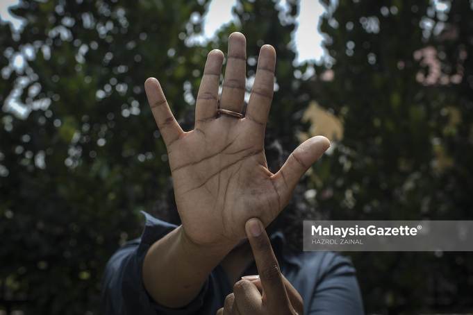 The domestic abuse victim showing her old wounds that are believed to be caused by her husband during an interview in Shah Alam, Selangor. PIX: HAZROL ZAINAL / MalaysiaGazette / 18 JULY 2021.