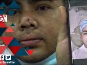 MGNews: Hidung Lekuk Selepas Bedah, Individu Ini Saman Klinik Terkenal RM2.7 Juta!