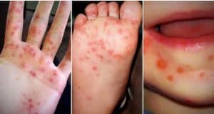 HFMD hand, foot and mouth disease Malaysia children cases ICU encephalitis