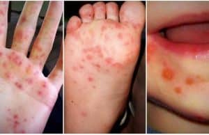 HFMD hand, foot and mouth disease Malaysia children cases ICU encephalitis