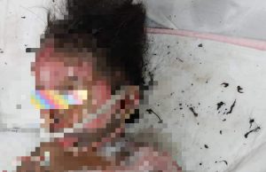 Budak 5 tahun melecur separuh badan akibat mercun