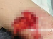 Paha kanan koyak diserang tiga ekor anjing jiran – Mangsa