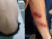 Pelajar Kolej Vokasional dakwa cedera dirotan guru