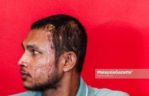 Selangor masih tunggu laporan siasatan kes simbah asid ke atas Faisal