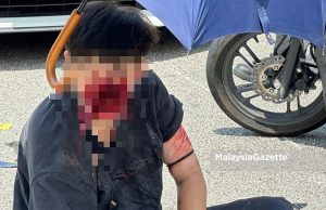 Pelajar 15 tahun terpaksa bedah muka akibat kemalangan