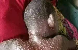 50 Kematian baharu akibat wabak Mpox direkodkan