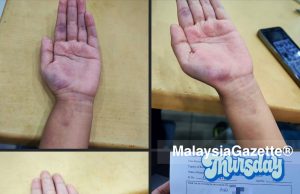 JPN P.Pinang siasat dakwaan murid Tahun Dua dirotan guru sampai bengkak