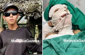 Remaja OKU bertarung nyawa akibat melecur terkena minyak panas