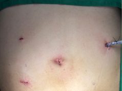 Pembedahan usus tanpa luka besar